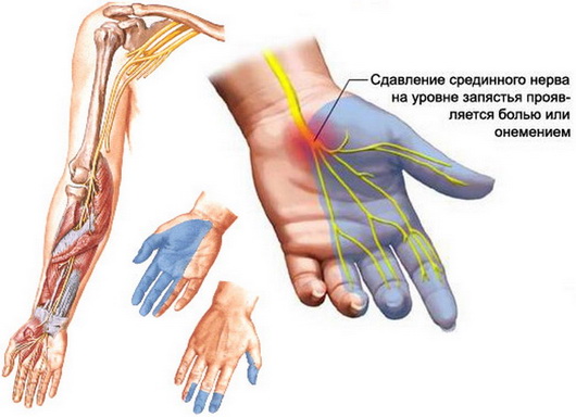 Немеют пальцы рук - что делать. По какой причине немеют пальцы левой и правой рук и какое лечение самое эффективное.