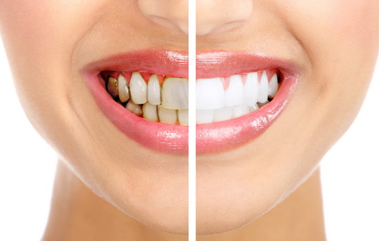 Зубной камень – как удалить в домашних условиях быстро и эффективно. Лучшие способы для борьбы с зубным камнем