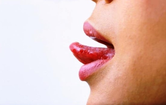 Воспаление языка - причины, симптомы и лечение. Как избежать тяжёлых проявлений воспаления языка