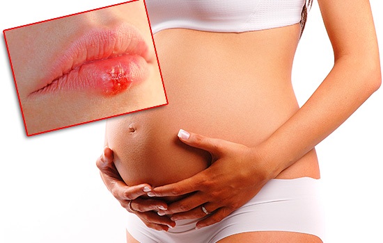 Как лечить герпес на губах при беременности