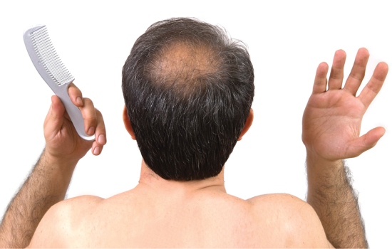Будет лысина ли нет: как узнать заранее и предотвратить выпадение волос у мужчин