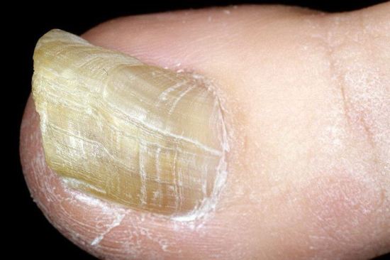 Простая диагностика: состояние ногтей указывает на болезни