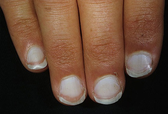 Простая диагностика: состояние ногтей указывает на болезни