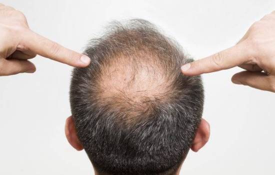 Выпадение волос: обнаружено новое лекарство, ускоряющее рост волос