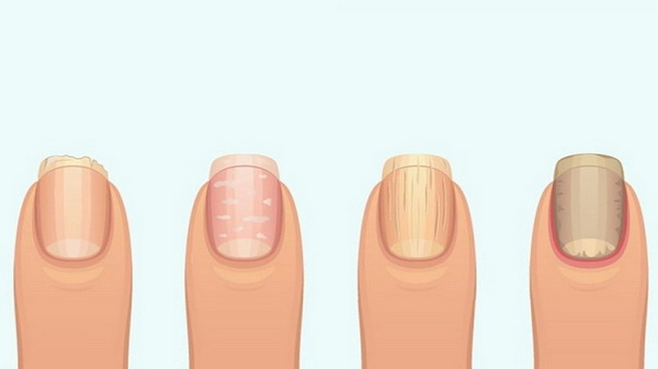 Какие заболевания можно диагностировать по внешнему виду и форме ногтей