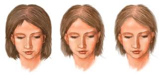Алопеция (выпадение волос) - причины, симптомы, диагностика, лечение