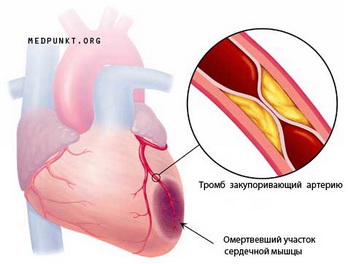 Инфаркт - причины, симптомы, диагностика, лечение