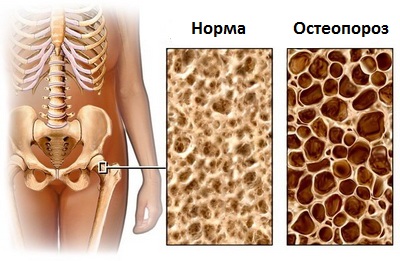Остеопороз - причины, симптомы, диагностика, лечение