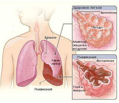 Пневмония - причины, симптомы, диагностика, лечение