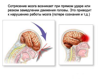 Сотрясение мозга - причины, симптомы, диагностика, лечение
