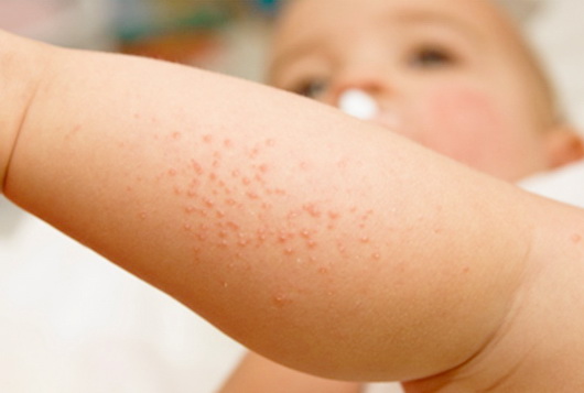 Сыпь у ребенка - на лице, животе, спине, лице, руках или ногах - что означает. Какие бывают виды сыпи у детей и как лечить.