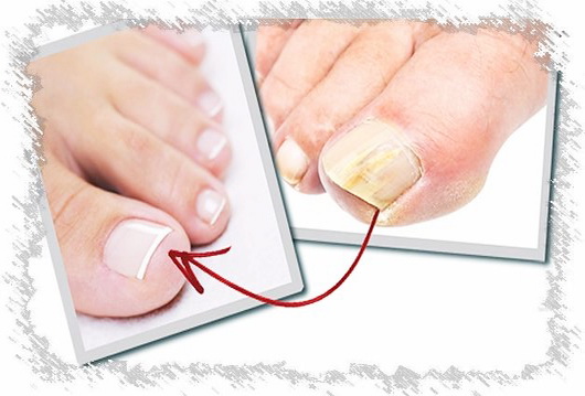 Грибок ногтей на ногах - чем лечить. По какой причине появляется грибок ногтей на ногах и какие средства эффективны в домашних условиях.