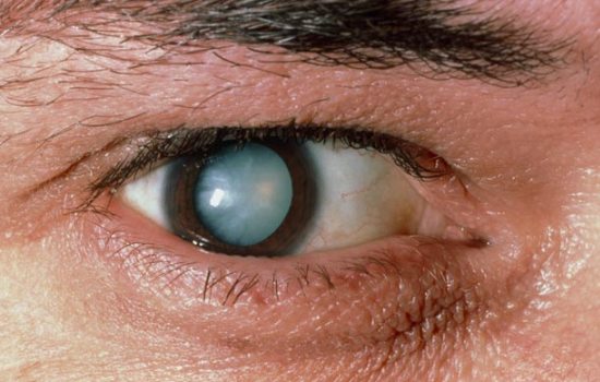 Лечение катаракты народными средствами на начальной стадии. Как вылечить катаракту народными средствами без операции?