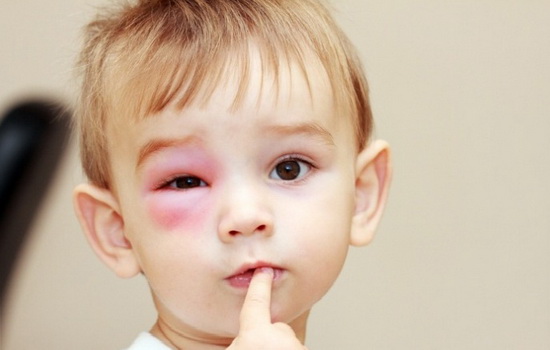 Ушиб глаза: это очень опасная травма! Как лечить ушиб глаза, какие симптомы показывают, что нужна помощь врача?