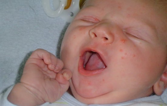 Сыпь на лице у новорождённого — причины. Что делать при появлении сыпи на лице новорождённого