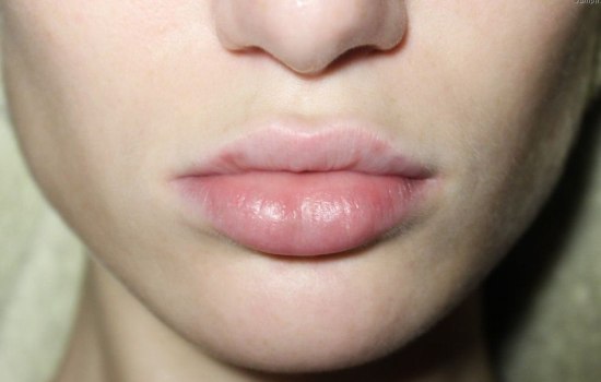 Что делать, если сильно опухла губа изнутри? Почему нельзя пускать это на самотёк?