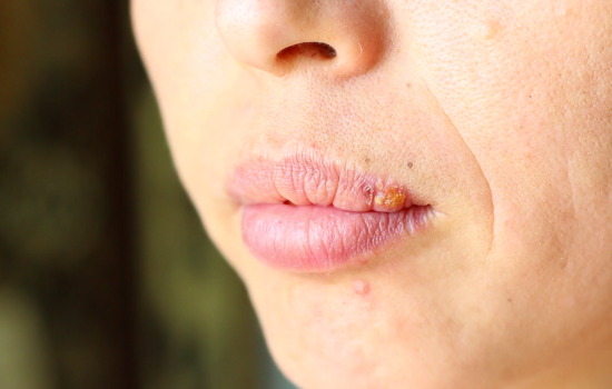 Можно ли быстро вылечить герпес на губах? Рейтинг самых эффективных современных препаратов от герпеса